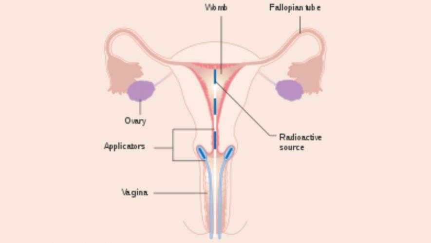 Cervical Cancer